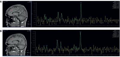 Alterations of Metabolites in the Frontal Cortex and Amygdala Are Associated With Cognitive Impairment in Alcohol Dependent Patients With Aggressive Behavior